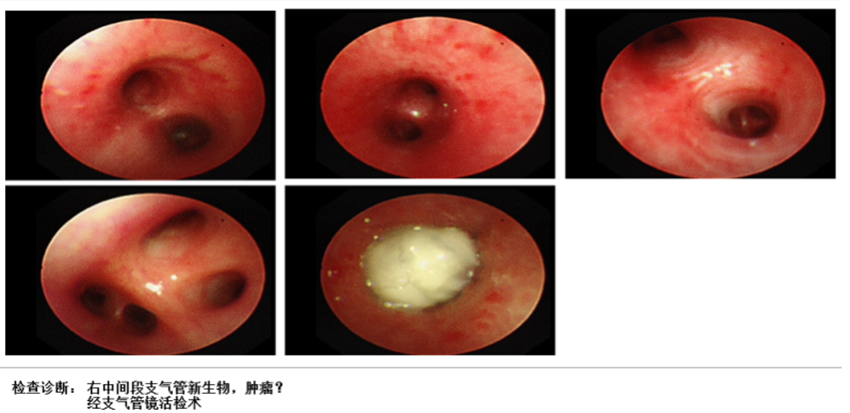3 支气管镜检查示右中间段支气管新生物；支气管镜活检提示为粘液表皮样癌.png