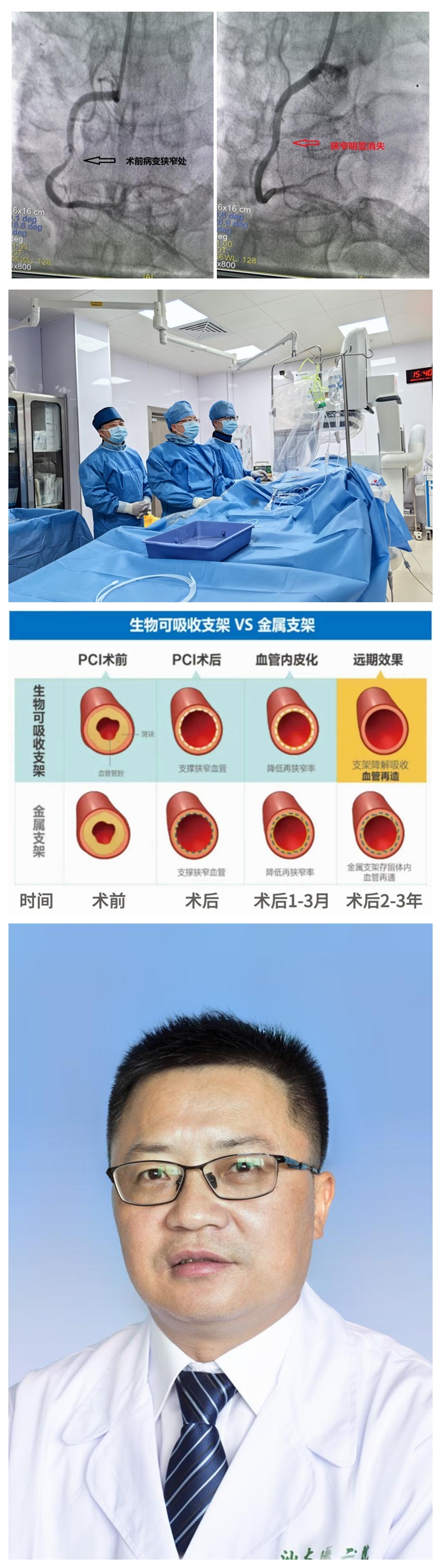 20231119-附二可吸收支架新闻稿.jpg